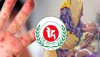 আতঙ্ক! ২৪ ঘণ্টায় হাম ও উপসর্গে ১৭ শিশুর মৃত্যু, আক্রান্ত আরও ১২২৪