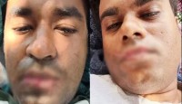 নাউরুতে মুখ সেলাই করে দুই বাংলাদেশির প্রতিবাদ