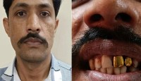 সোনার দাঁতের কারণে ১৫ বছর পর ধরা পড়ল পলাতক আসামি